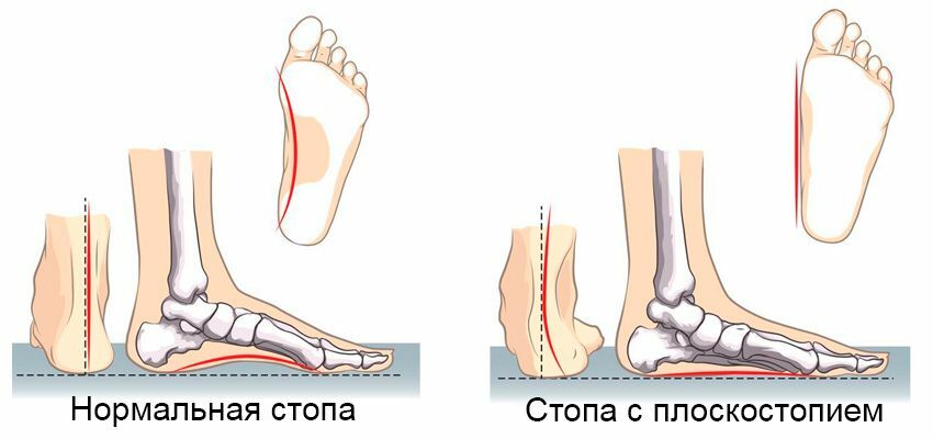 Стопа с плоскостопием