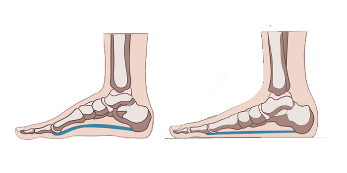 Плоскостопие
