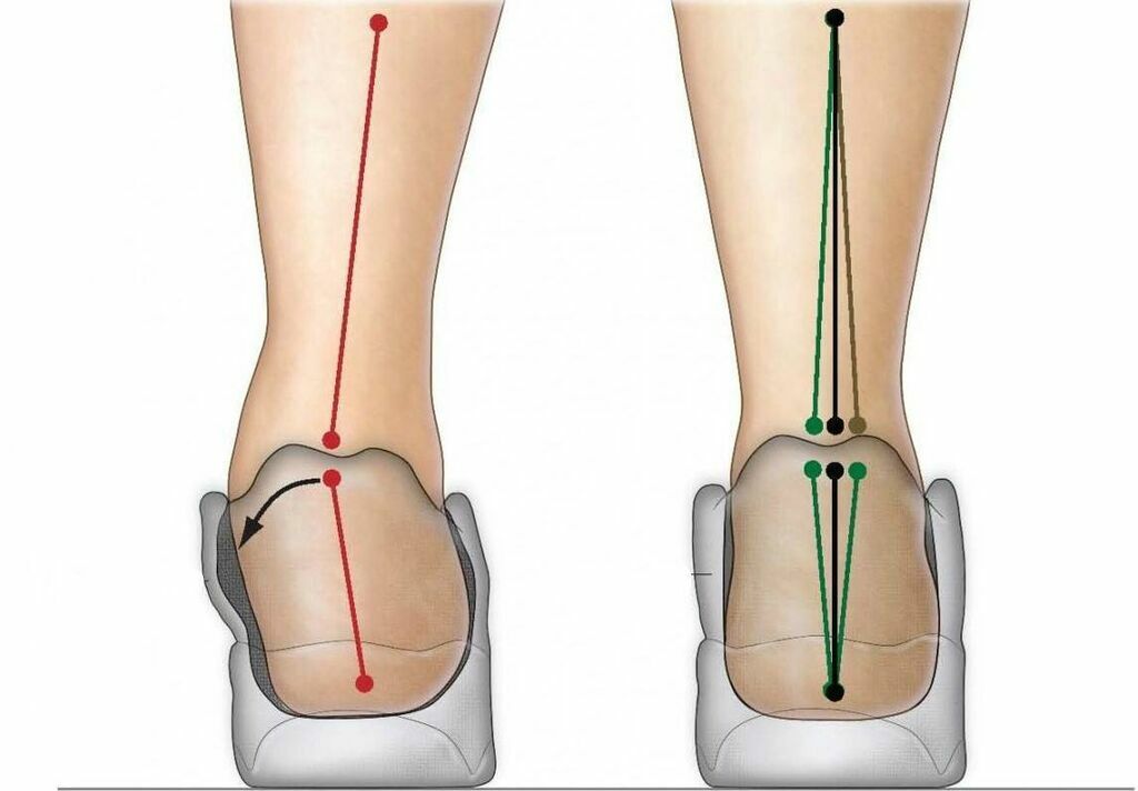 Вальгус голеностопа